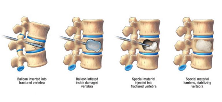 Kyphoplasty Featured Img Interventional Radiology